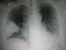 Het omcirkelde gebied op de röntgenfoto laat een longontsteking zien; deze wordt veroorzaakt door bacteriën. Bij een gezond persoon zou de long zwart moeten lijken, maar water in de long maakt hem wit op een röntgenfoto