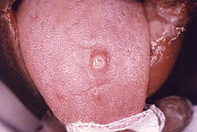 Chancre (douleur) sur la langue, causé par la syphilis au stade primaire.