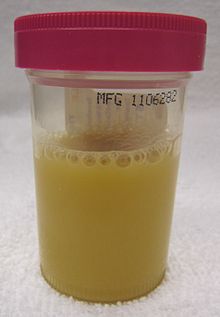 Urine kan etter (een aandoening die bekend staat als pyurie) bevatten, gezien vanuit een persoon met sepsis als gevolg van een urineweginfectie.