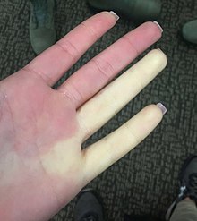 Raynaud está afetando dois dedos em mulheres