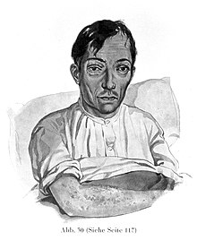 Rysunek pacjenta z szkorbutem, Karl Heinrich Baumgaertner, 1929