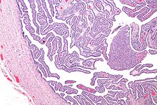 Micrografía de salpingitis - un componente de la enfermedad inflamatoria pélvica. Tinción H&E.
