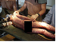 Lesión secundaria por explosión Heridas de metralla de un artefacto explosivo improvisado (IED).  