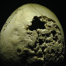 Parte de um crânio humano danificado por neurossífilis tardios.
