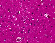 Tecido cerebral "esponjoso" causado pela morte de células cerebrais da CJD