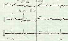 typical 6-channel ECG