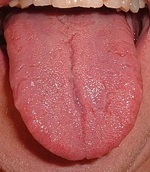 Tongue of the human being. The picture shows a special finding, namely a folded tongue (lingua plicata).