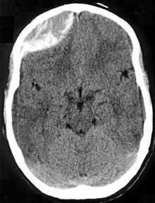 Exame do cérebro de uma hemorragia cerebral. A área cinza claro na parte superior esquerda é o sangue, que está espremendo o cérebro (a área cinza escuro).