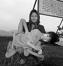 A 14-year-old boy with severe mental and physical disabilities whose deformities are attributed to his parents' exposure to Agent Orange.