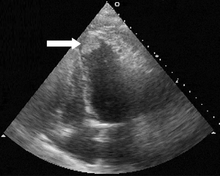 Ultrasound image of a thrombus (arrow) of the left ventricle