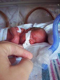 Bebê prematuro em uma incubadora