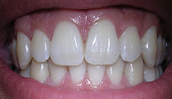 Dentes humanos saudáveis