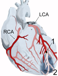 Myocardial infarction of the anterior wall apex (2) after occlusion (1) of the anterior descending branch (LAD) of the left coronary artery (LCA), schematic diagram