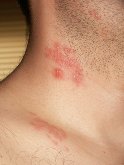 Herpes zoster en el cuello de un paciente  