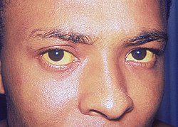 Marked yellowing of the sclerae and facial skin, in this case caused by hepatitis A