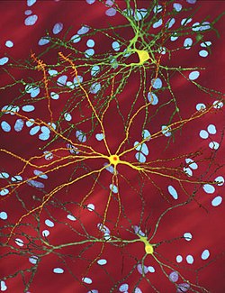 Mikroskopický snímek středně ostnatých neuronů (žlutá) s jadernými inkluzemi (oranžová): ty jsou způsobeny onemocněním.  