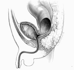 Een rectobladder hals fistel, tussen de blaas en het rectum