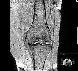 Medial gonarthrosis MR image of an osteoarthritic knee joint. The osteophytes in the medial (middle) and lateral (side) areas of the joint space and the wear or abrasion of the cartilage layer in the left area of the image are clearly visible. The bone of the tibial plateau in the medial region is compacted, a response to increased mechanical stress. The cartilage layer has lost its cushioning function.