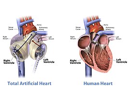 Corazón artificial total junto a un corazón humano  