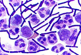 Grampositiva Bacillus anthracis-bakterier (lila stavar) i prov från cerebrospinalvätska. De andra cellerna är vita blodkroppar.  
