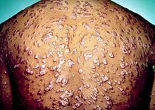 Rötliche Papeln und Knötchen über weite Teile des Körpers aufgrund von Sekundärsyphilis