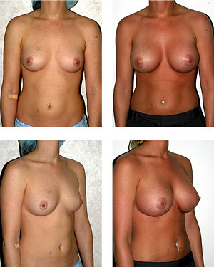 Breast augmentation: before and after