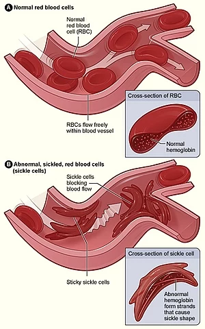 Na obrázku (A) jsou zobrazeny normální červené krvinky proudící žilami.  Dolní obrázek (B) ukazuje abnormální, nemocné červené krvinky hromadící se v žíle.  