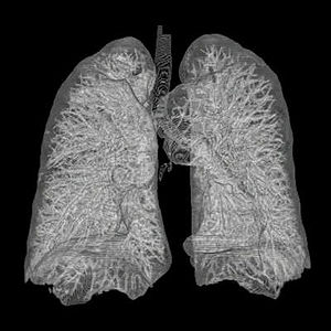 3D reconstruction of human lungs from CT images