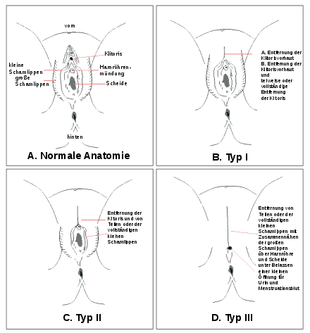 Types of circumcision (according to WHO): A Normal anatomy B Clitoral prepuce and, where appropriate, clitoris have been removed C Clitoral foreskin and, if applicable, clitoris and labia minora were removed D Clitoral prepuce and clitoris and labia minora were removed and the vaginal opening partially sutured closed