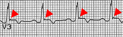 Epsilon wave (red arrow) as ECG indication of ARCM