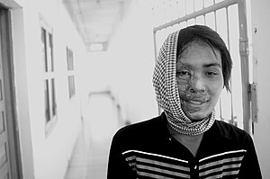 Slachtoffer van zuurgooien, Cambodja  