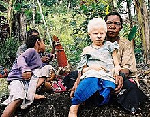Girl with albinism in Papua New Guinea