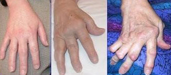 Hands with chronic polyarthritis (cP)