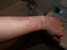 Het snijden van de onderarm is een veel voorkomende vorm van zelfverwonding.