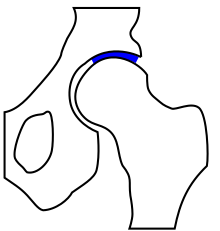 Hip joint - the main mechanical loading zone is shown in blue.