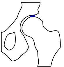 Hip joint dysplasia - the main mechanical stress zone is significantly reduced compared to the normal variant.