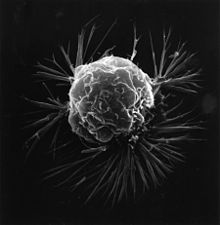 Breast cancer cell under a scanning electron microscope