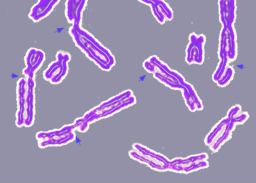 Poškodbe DNK, ki imajo za posledico več poškodovanih kromosomov.