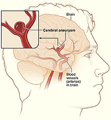 Diagrama de um aneurisma cerebral. Um derrame hemorrágico pode acontecer quando um aneurisma cerebral irrompe, como um balão estourado.