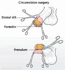 Operace obřízky pomocí hemostázy a nůžek