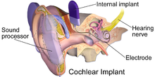 Una ilustración de un implante coclear.