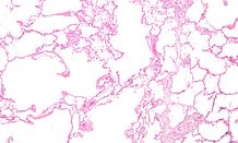 Ta mikroskopska slika prikazuje zelo velike razširjene dele pljučnega tkiva. Te "luknjice" bi morale biti majhne in moralo bi jih biti na tisoče, ne pa le na stotine.