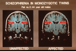 Vergrote laterale ventrikels bij schizofrenie  