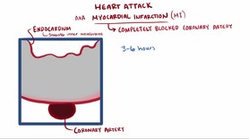 Play media file Video describes the mechanism of heart attacks (English)
