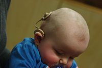 Ein Säugling mit einem Cochlea-Implantat.