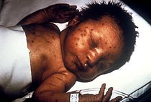 Lapsi, jolla on synnynnäisen vihurirokon aiheuttamia iho-ongelmia.  