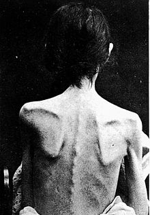 La schiena di una persona con anoressia