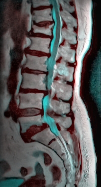 Een MRI van de menselijke wervelkolom. Het deel in blauw is het wervelkanaal. Ook is te zien dat één wervel is gebroken (L-3), wat betekent dat het ruggenmerg op één punt is samengedrukt (L-3,L-4 beknelling) .