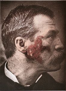 Ett handkolorerat foto från 1886 som visar lupus (de röda delarna i fotot).
