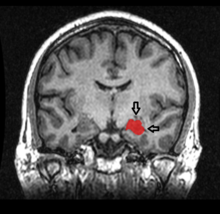 Vista coronale MRI di un ippocampo mostrato in rosso